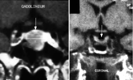 Decrease in Size of Prolactinoma