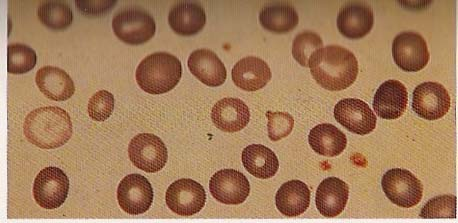 Εικόνα 5 : A) Μεγαλοβλαστική ερυθροποίηση µε κυτταρόπλασµα δίκην φυσαλλίδας (µυελός οστών). Β) Πολυπύρηνο πρόδροµο κύτταρο της ερυθράς σειράς (µυελός οστών).