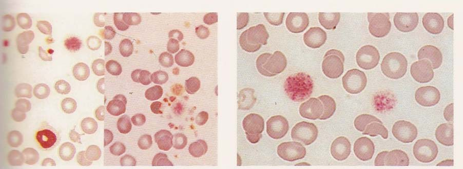 Εικόνα 7 : Μ Σ περιφερικό αίµα. Αριστερά, γιγάντια αιµοπετάλια, ανωµαλίες ερυθροκυττάρων και ουδετερόφιλο µε δακτυλιοειδή πυρήνα. εξιά, γιγάντια, δυσµορφικά αιµοπετάλια.