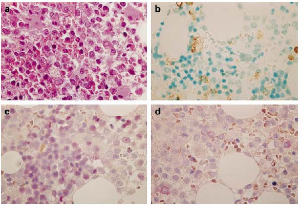 Εικόνα 11 : Φωτογραφίες (Χ400) από τοµές µυελού ασθενούς µε RAEB. A) Υπερκυτταρικός µυελός µε µέτρια αύξηση των άωρων µυελοειδών κυττάρων και διασκορπισµένα άτυπα µεγακαρυοκύτταρα.