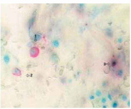 Εικόνα 13 : Μεγέθυνση Χ400. Άνω αριστερά, τοµή µυελού από ασθενή µε RA. Είναι ορατά τα µικρο µεγακαρυοκύτταρα (1,2)(CD41 + ) και τα αποπτωτικά µεγακαρυοκύτταρα (3)(ISEL + ).