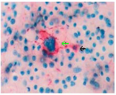 Εικόνα 14 : Μεγέθυνση Χ400. Τοµή µυελού από ασθενή µε RAEB. Το πράσινο βέλος δείχνει ένα µορφολογικά φυσιολογικό, µη αποπτωτικό CD41 + µεγακαρυοκύτταρο.
