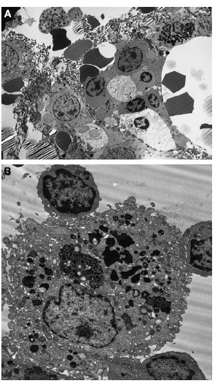 Εικόνα 17 : Αποπτωτικά κύτταρα σε Μ Σ. Ηλεκτρονικό µικροσκόπιο. Α) Απόπτωση µυελοειδούς και ερυθροειδούς σειράς.