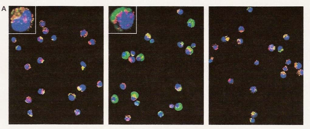 Εικόνα 21 : Αυτόµατη απελευθέρωση του κυτοχρώµατος C από τα µιτοχόνδρια σε πρόδροµα κύτταρα του µυελού από Μ Σ ασθενείς : Αναστολή από G-CSF.