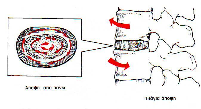 Μεσοσπονδύλιοι δίσκοι 4 Η στροφή της σπονδυλικής στήλης δημιουργεί τάση διάτμησης στο εσωτερικό