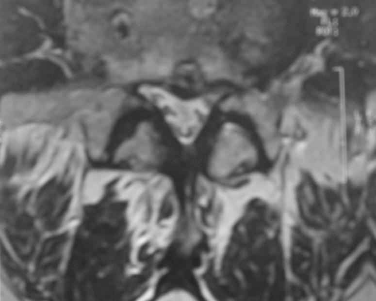 Περίπτωση 1 η MRI. Δεν επανελέγχεται η αριστερά πλάγια κήλη.