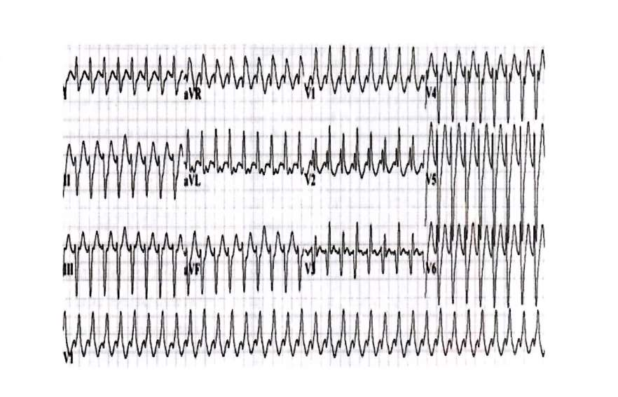 22 χρόνων άνδρας RBBB με