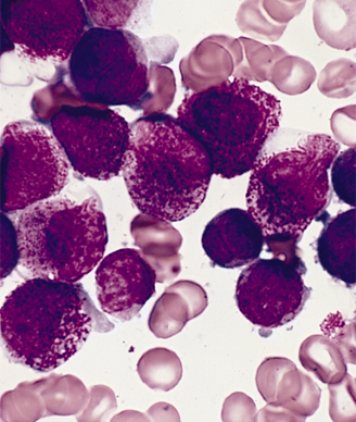 Οξεία προμυελοκυτταρική λευχαιμία Διάγνωση Κλινική εικόνα Συστηματικά συμπτώματα Αιμορραγική διάθεση (60-80%) Ε/Ε