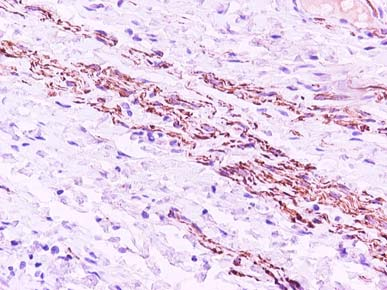 65 κρυψορχία. εν αναδείχθηκαν κύτταρα που να εκφράζουν το µονοκλωνικό αντίσωµα bcl-2. Η βιµεντίνη εκφράζεται διάχυτα στην µεσοθηλιακή στιβάδα των κηλικών σάκων.