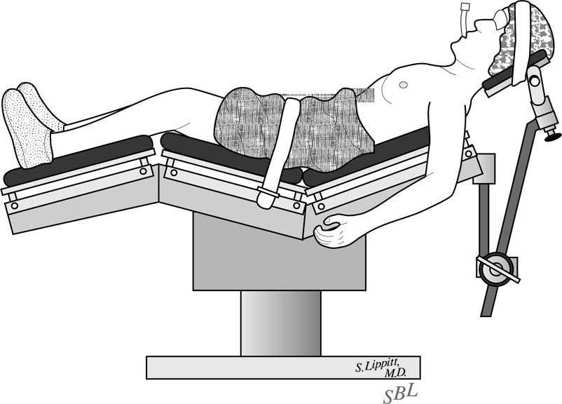 Η πρόθεση που χρησιµοποιήσαµε είναι η Global Fx - DePuy Inc. ( κατασκευάζεται από κράµµα Χρωµίου Κοβαλτίου) και το µεταγενέστερο µοντέλο Global Advantage - DePuy Inc. (κατασκευάζεται από τιτάνιο).