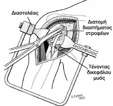 Μ.Κ.. βρίσκεται το Μ.Β.Ο. µε το Μυοτενόντιο Πέταλο ( Rotator Cuff / Υπερακάνθιος Υπακάνθιος Έλλασων Στρογγύλος ). Επί τα εντός της Μ.Κ.. βρίσκεται το Ε.Β.Ο. µε τον Υποπλάτιο Μυ. Σχήµα 16.