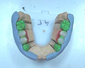 Εικόνα 16.30 Δεύτερο διαγνωστικό κέρωμα με διαμόρφωση των δευτερευουσών στεφανών και αποκατάσταση των νωδών περιοχών με ακρυλικά δόντια.