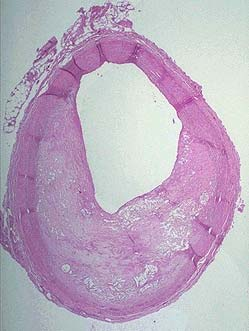 atherosclerosis results from the bad use of good vessels