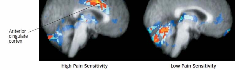Ο εγκέφαλος στον πόνο Μαγνητικές τομογραφίες της δραστηριότητας του εγκεφάλου σε ευαίσθητα στον οξύ (αριστερά) και ελαφρύ πόνο (δεξιά) ατόμων κατά τη διάρκεια οδυνηρών διεγέρσεων.