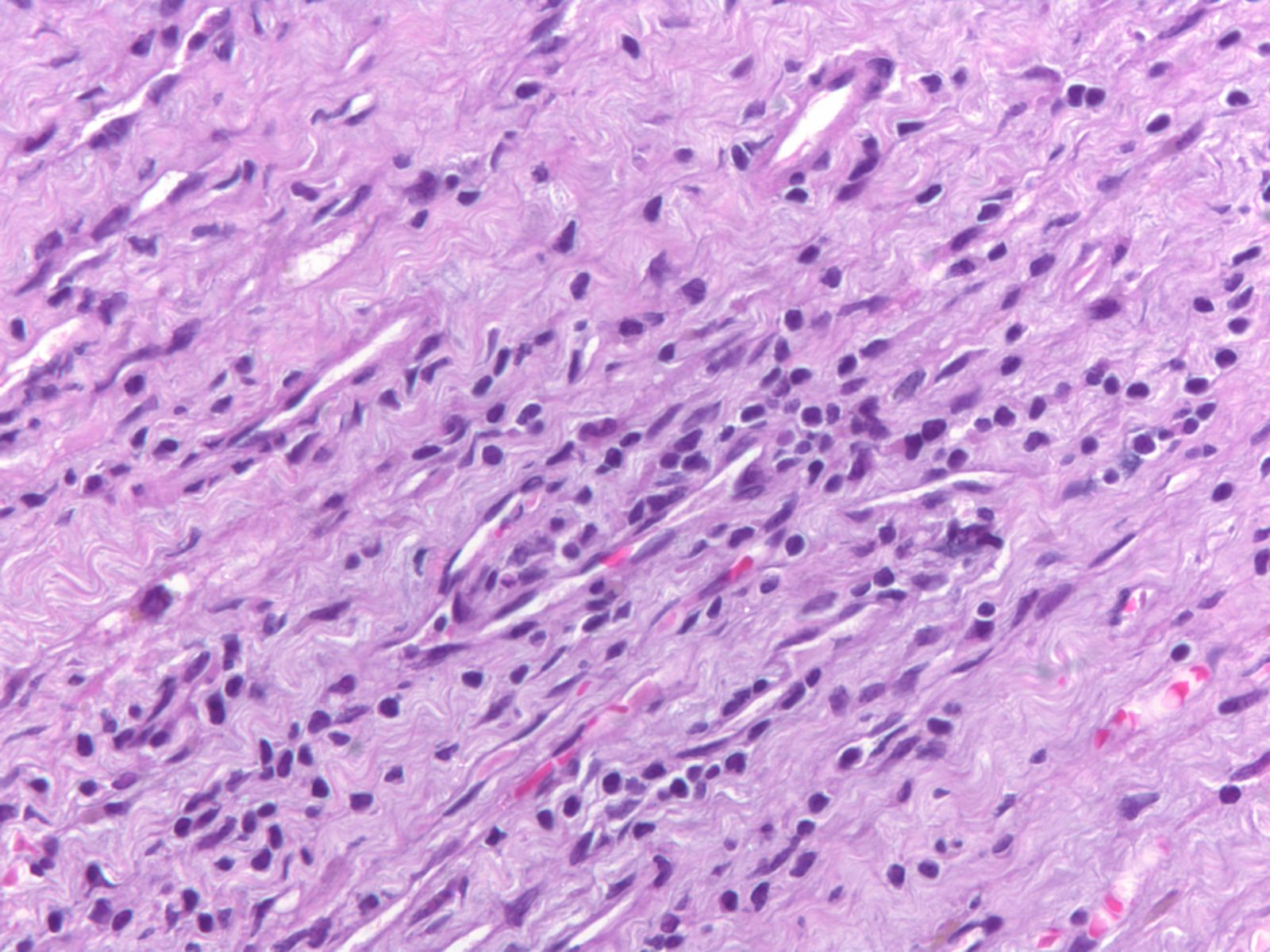 Βιοψία µυοκαρδίου ασθενούς Ασθενής KM (Cod 157-191) x10 x40