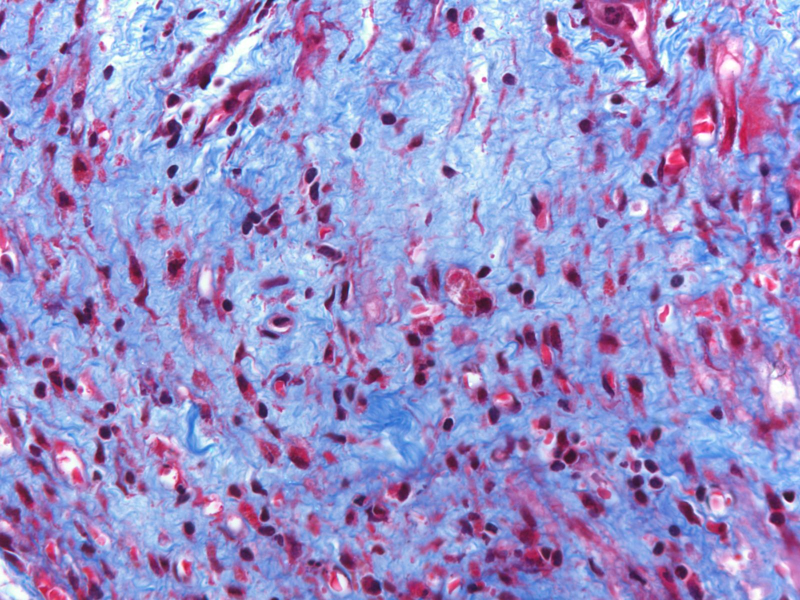 Βιοψία µυοκαρδίου ασθενούς Ασθενής KM (Cod 157-191) x10 x40
