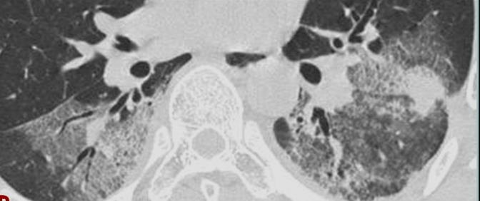 CT Περιφερικές, μη τμηματικές,υποϋπεζωκοτικές πυκνώσεις (100%) στα άνω και μέσα πνευμονικά πεδία.
