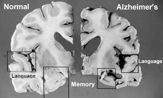 7 observational studies 1 τυχαιοποιημένη μελέτη Μειωμένη επίπτωση της Ν.