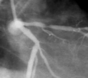 Myocardial Fractional Flow Reserve: Definition Fractional Flow Reserve is a ratio FFR = Q s max max Q N maximal myocardial flow in the