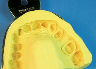 Clinical C-Silicone Impression Material μα υψηλής ευκρίνειας.