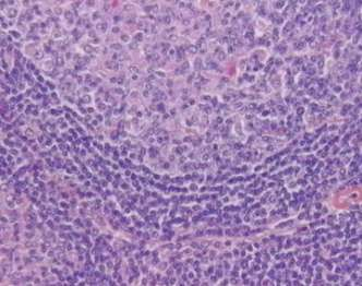 Δευτερογενή λεμφοζίδια κύτταρα βλαστικού κέντρου : μεγάλα ενεργοποιημένα Β κύτταρα ή λεμφοβλάστες, λεμφοζιδιακά δενδριτικά κύτταρα