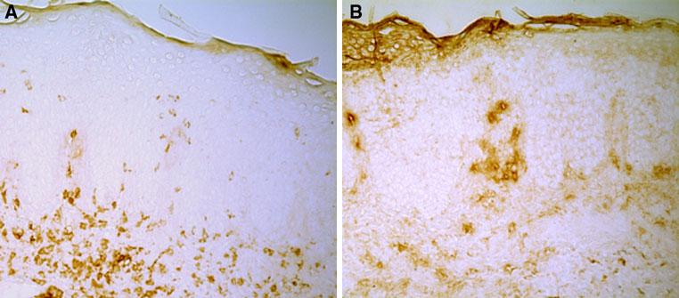 Infiltrates in papillary dermis in a psoriatic plaque