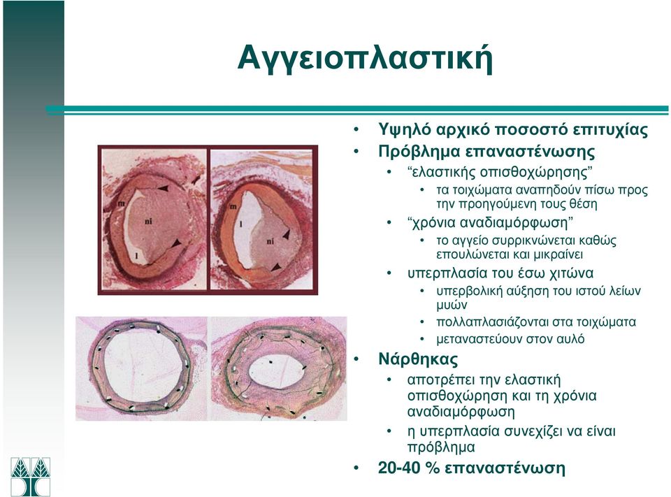 του έσω χιτώνα υπερβολική αύξηση του ιστού λείων µυών πολλαπλασιάζονται στα τοιχώµατα µεταναστεύουν στον αυλό Νάρθηκας