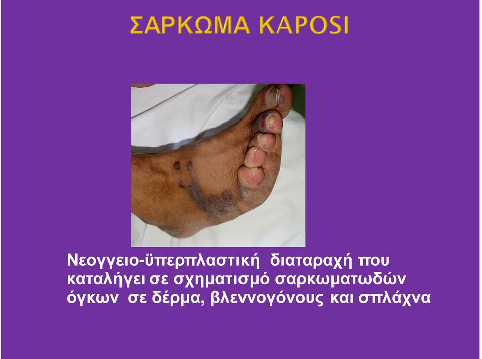 σχηματισμό σαρκωματωδών