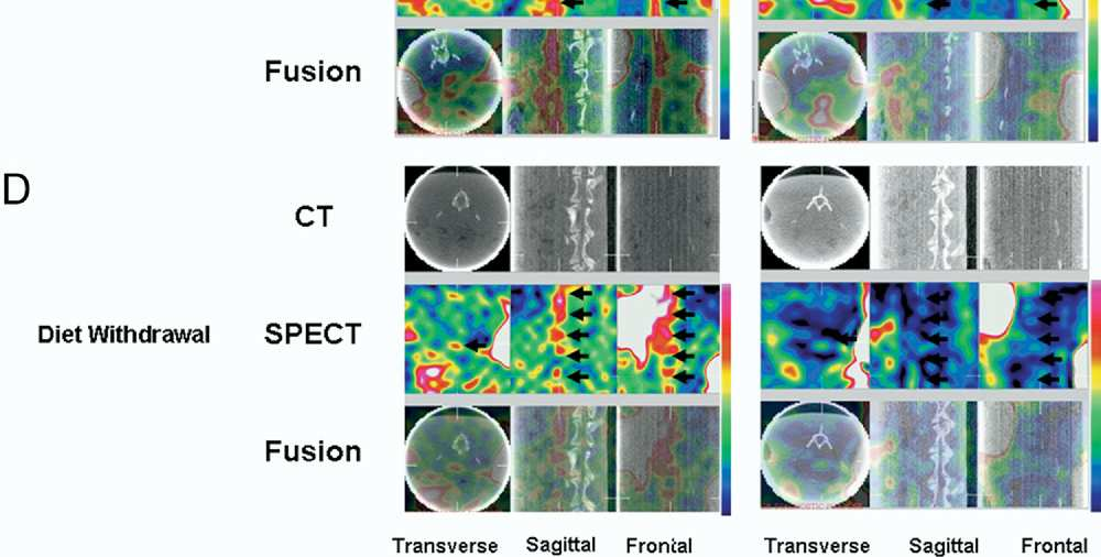 Molecular Imaging of Matrix Metalloproteinase in Atherosclerotic Lesions Resolution With Dietary Modification and Statin, (99mTc conjugated to the broad-spectrum, MMP-inhibiting macrocyclic compound