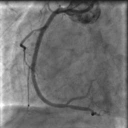 ΙΕΝΕΡΓΕΙΑ ΑΓΓΕΙΟΠΛΑΣΤΙΚΗΣ Το IVUS επιβεβαίωσε την καλή και συµµετρική έκπτυξη του stent µε καλή εναπόθεση των struts στο τοίχωµα του γγείου.