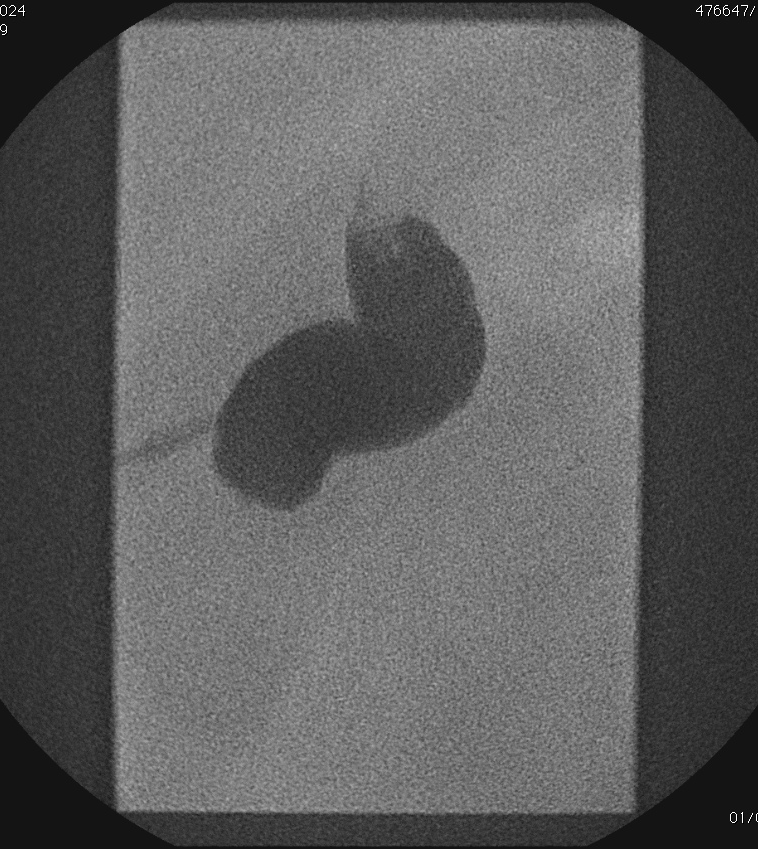 Percutaneous cholecystostomy Gallbladder access (>95%) Cholecystitis Removal of stones Biliary tract access (<5%) Decompression Divert bile from