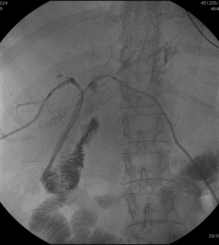 Percutaneous transhepatic biliary drainage PTBD therapeutic procedure : PTC followed by imaging-guided wire and catheter manipulation.