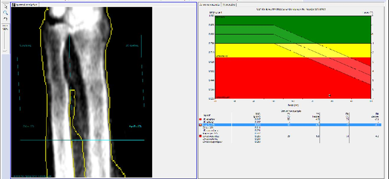 Σε όλους του ασθενείς διενεργήθηκε μέτρηση της οστικής πυκνότητας στην
