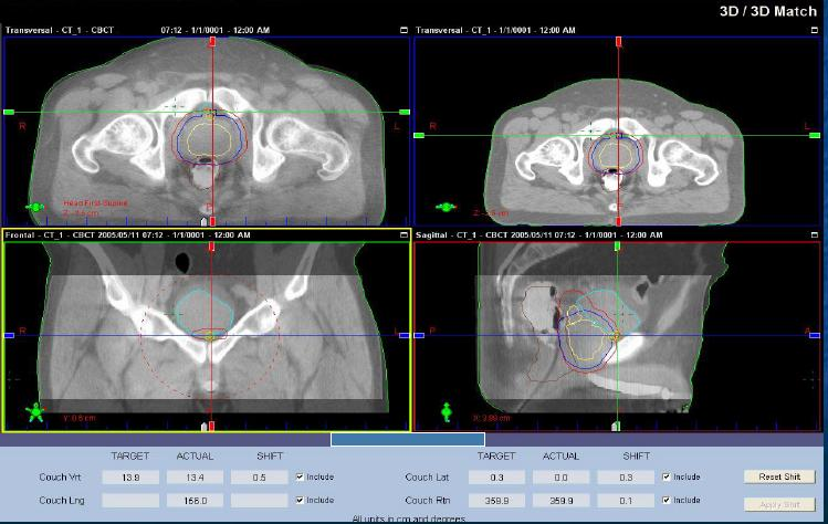 Εικόνες 1 (αριστερά) και 2 (δεξιά). Παράδειγμα σύγκρισης εικόνων αξονικής τομογραφίας σχεδιασμού και CBCT για την εφαρμογή IGRT σε ασθενή με καρκίνο του προστάτη σε πραγματικό χρόνο (real time).