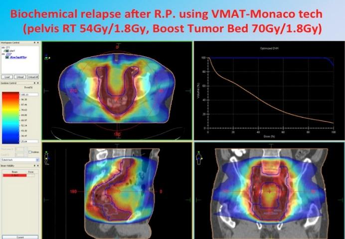 Εικόνα 3 Ανάδειξη της υπέροχης της τεχνικής IMRT σε σχέση με την 3DCRT στην αποφυγή ακτινοβόλησης μεγάλου μέρους του ορθού (κύκλος) σε ασθενή με καρκίνο του προστάτη.