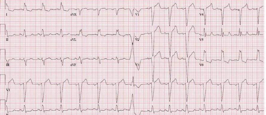 LBBB in athletes LBBB is extremely