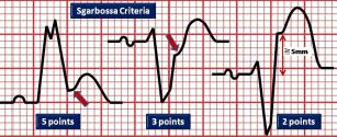 LBBB and AMI Sgarbossa