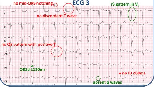 LBBB? Recently, Strauss et al. has suggested changes in the criteria for definition of LBBB.