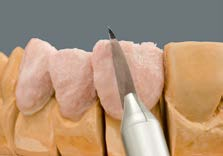 Επίστρωση STANDARD στο παράδειγμα μίας γέφυρας διαμορφώνεται το υλικό DENTINE στην ολοκληρωμένη μορφή του δοντιού.