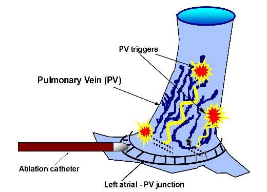 Ablation