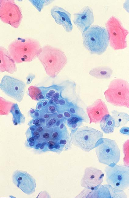 Πρόληψη για καρκίνο τραχήλου μήτρας: Pap test (G.