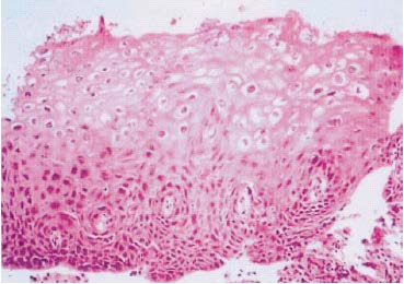Κλινική πορεία HPV λοίμωξης Επιβάλλεται μοριακή ανίχνευση του HPV ιού (οδηγίες ASCCP)!