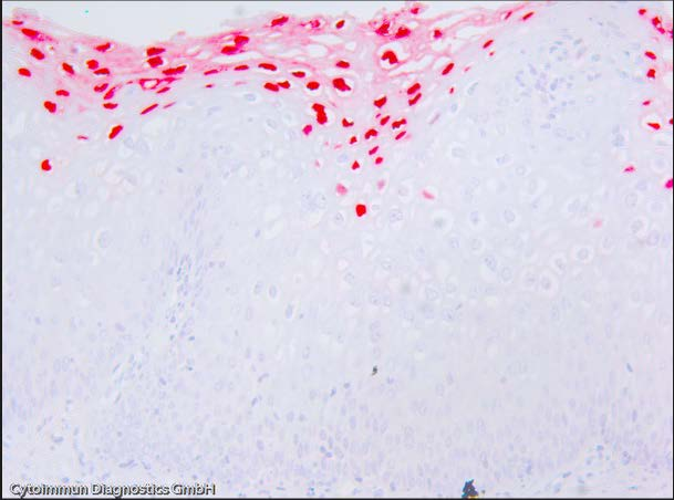 C. Protein detection of HPV infection Viral HPV proteins a) Cytoactiv L1 protein IHC (Cytoimmun) b) In house E4 protein IHC Host