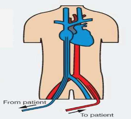 ECMO SYSTEM CATH