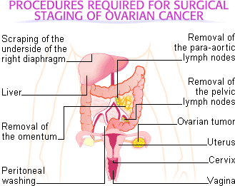 Procedures required for surgical staging of ovarian cancer.