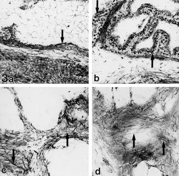 VEGF και ΚΥΠ/BOO Botelho F et al. Int Braz J Urol 2010 Η μερική απόφραξη στα ζώα οδηγεί σε υποξία και αυξημένα επίπεδα VEGF/αγγειογένεση στην ουρ.