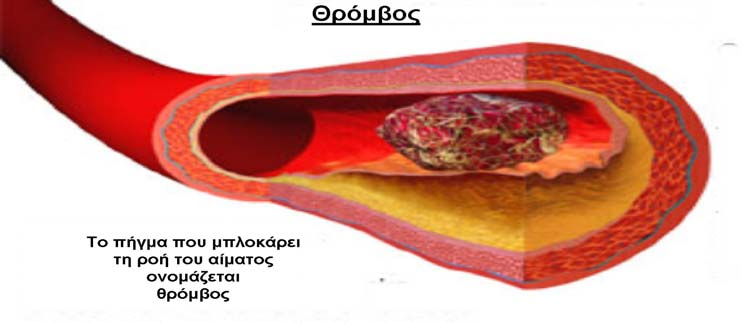 Α.3. Η πήξη του αίµατος Το δεύτερο βήµα ενεργοποίησης της αιµόστασης αποτελεί το σύνολο της αλληλοδιάδοχης ενεργοποίησης των πρωτεϊνών του πλάσµατος (παραγόντων πήξης, πίνακας Α.1.