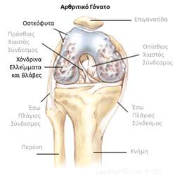3.2.3 Επιγονατιδομηριαία Παθολογία Η επιγονατιδομηριαία άρθρωση είναι από τις πιο κοινές περιοχές πόνου στο γόνατο.