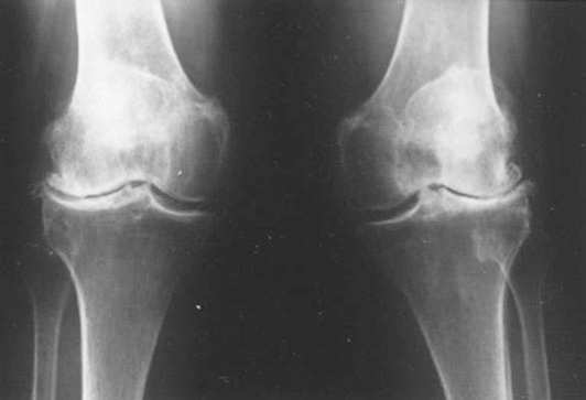 Σχήμα 3.4: Πρόσθια ακτινογραφία και των δύο γονάτων μιας 70-χρονης με οστεοαρθρίτιδα και στα δύο γόνατα, συνοδευομένη από βλαισότητα.