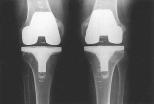 άρθρωσης (Σχ. 4.2). Περίπου 250 000 αρθροπλαστικές εκτελούνται ετησίως στις Η.Π.Α., με τη μέση ηλικία των ασθενών που λαμβάνουν μια ολική αντικατάσταση γόνατος να είναι τα 65 70 έτη.